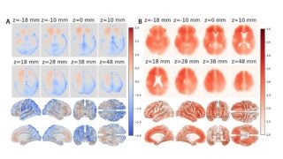 AI-generated maps of local brain aging