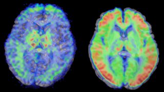 Brain MRIs